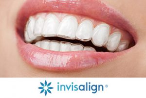 invisalign-1-2
